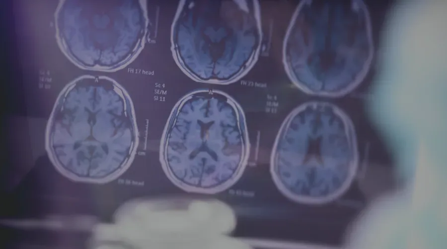 Alzheimer’s and Medical Marijuana