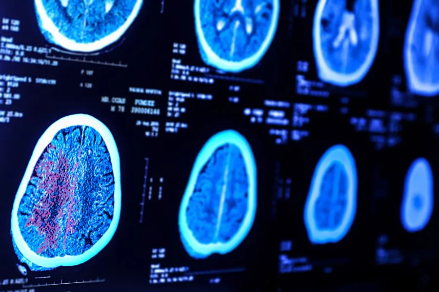 Cerebral Palsy and Cannabis: What We Know About Medical Cannabis and Spasticity