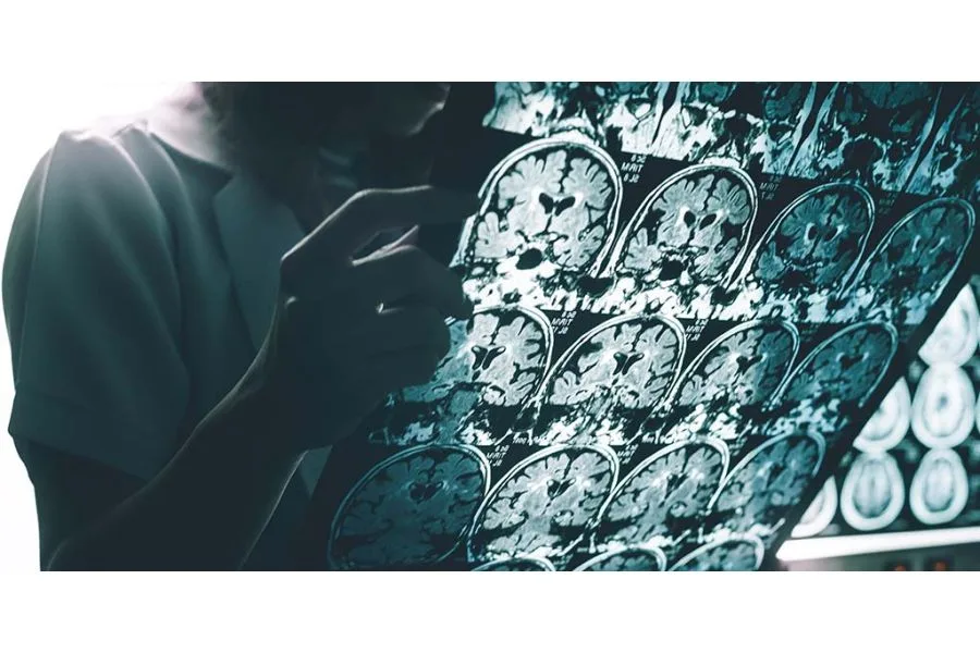 CBD Dosing Recommendations and Guidelines for Treatment of Intractable Epilepsy